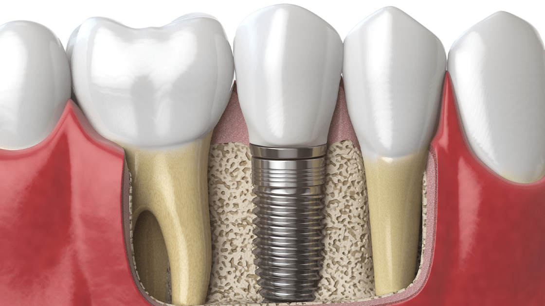 Dental Implant